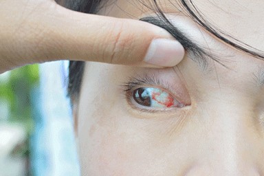 conjunctivitis